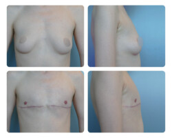 Top Surgery Before and After Dr. Jenq Plastic Surgery Portland OR Metro