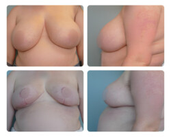 Improved confidence and comfort going from size G down to size B Breast Reduction Before and After Board Certified Plastic Surgeon Portland Metro