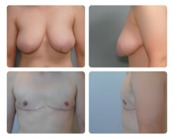 Top Surgery Before and After Dr. Jenq Plastic Surgery Portland OR Metro