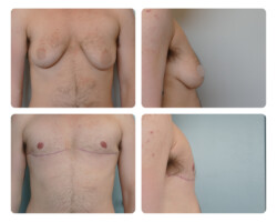 Chest masculinization with nipple grafts, 2 months after surgery, testosterone for several years Top Surgery Before and After Dr. Jenq Plastic Surgery Portland OR Metro