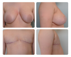 Top Surgery Before and After Dr. Jenq Plastic Surgery Portland OR Metro