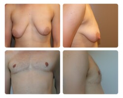 Top Surgery Before and After Dr. Jenq Plastic Surgery Portland Metro