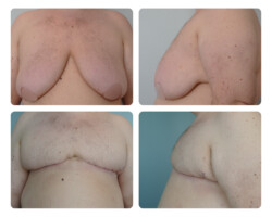 Double incision mastectomy Before and After Portland Plastic Surgery