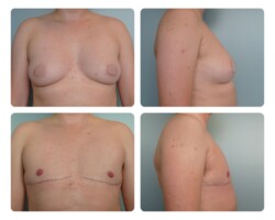 Top Surgery before and after Portland Plastic Surgery
