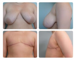 gender affirming top surgery before and after photos Portland Plastic Surgery