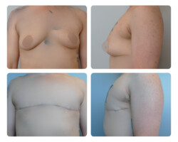Top Surgery Before and After Portland Oregon Plastic Surgery