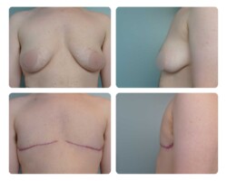 Top Surgery before and after Oregon Plastic Surgery Dr. Tina Jenq