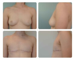 top surgery before and after