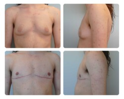 Top surgery before and after