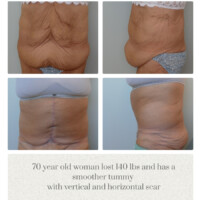 Massive weight loss tummy tuck Portland before and after