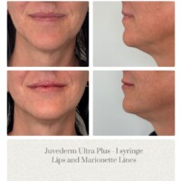 Juvederm Before and After Portland Plastic Surgery