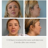 CO2 laser skin resurfacing for acne at Oregon Plastic Surgery