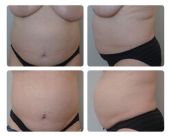 Liposuction Before and After Portland Plastic Surgery
