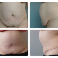 Before and After Tummy tuck
