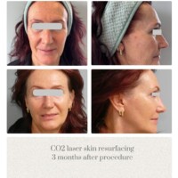 CO2 laser skin resurfacing before and after