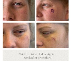 Excision skin atypia face Dr. Tina Jenq Portland Plastic Surgeon