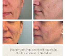 Scar revision face Plastic Surgeon Portland Oregon