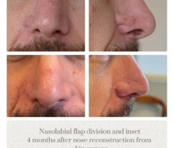 Nose reconstruction before and after Oregon Plastic Surgery Dr. Tina Jenq