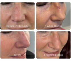 Nose precancerous mole removal before and after
