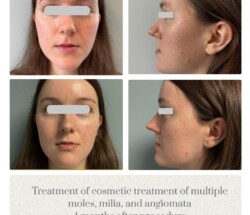 Cosmetic skin moles and tags