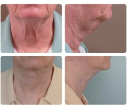 Portland Plastic Surgery Necklift before and after