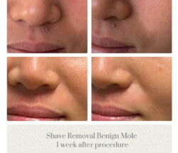 Shave Removal Face Mole Dr. Jenq Portland Plastic Surgeon