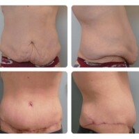 Tummy Tuck Before and After